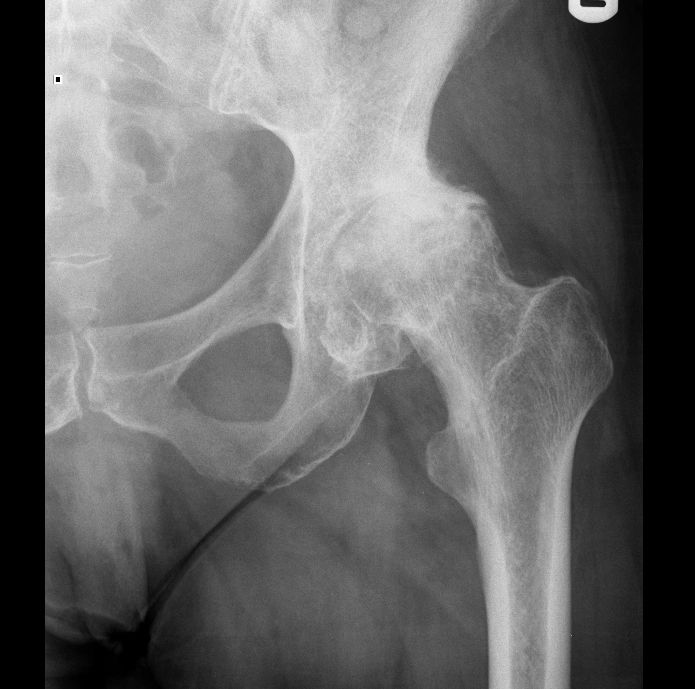 Hip or knee X-ray example