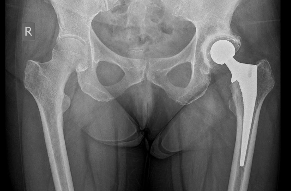 Hip or knee X-ray example