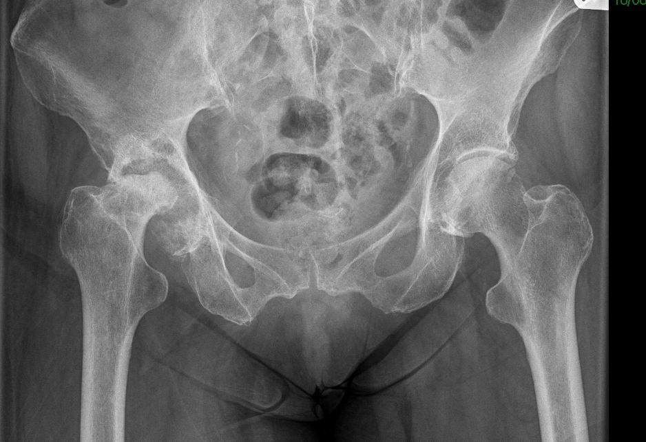 Hip or knee X-ray example