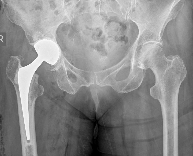 Hip or knee X-ray example