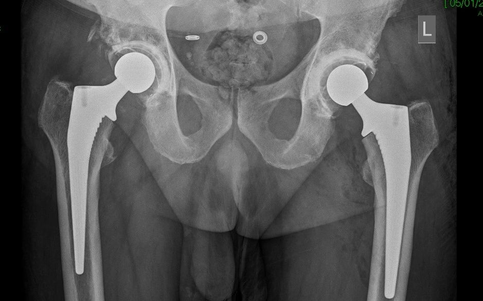 Hip or knee X-ray example