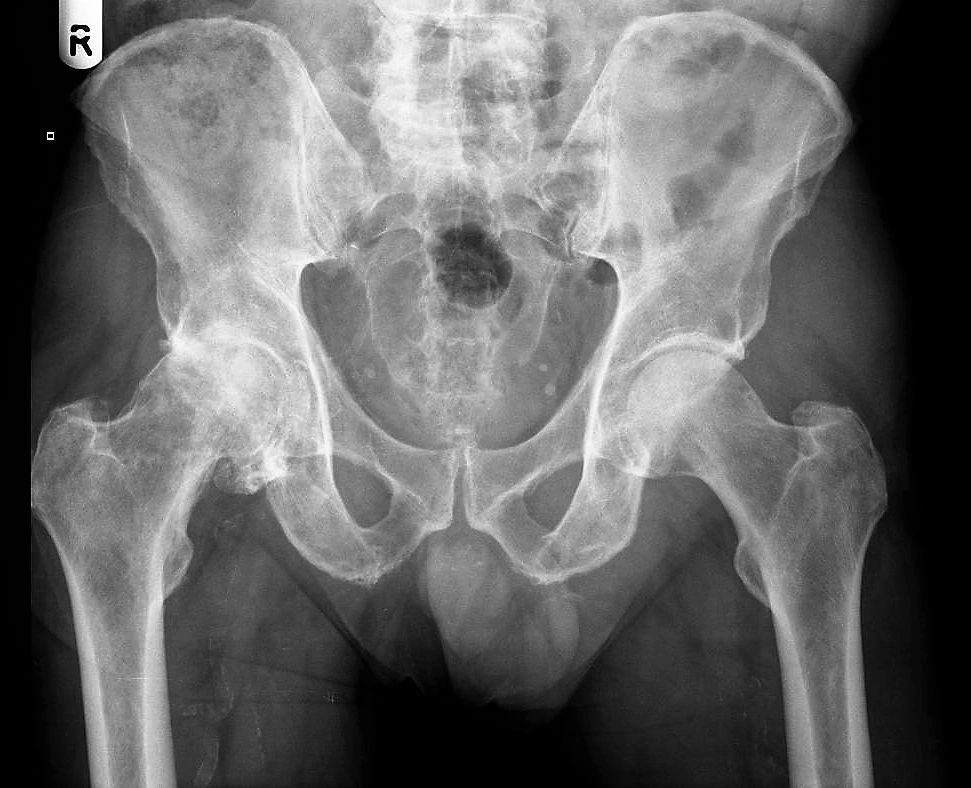 Hip or knee X-ray example