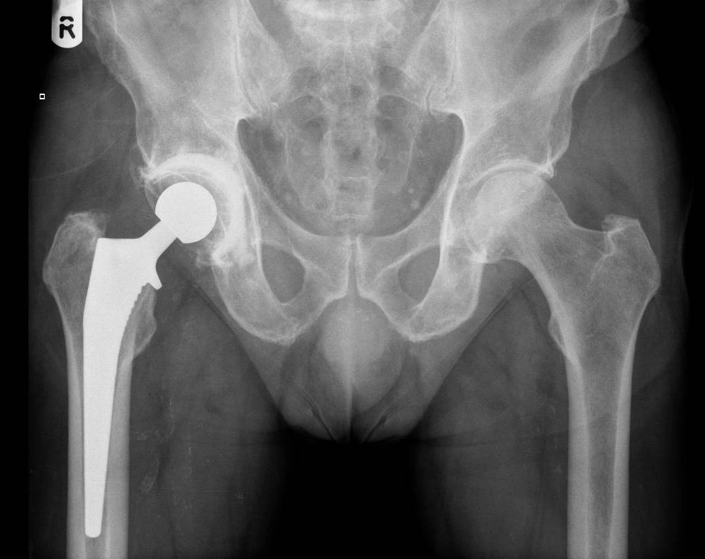 Hip or knee X-ray example