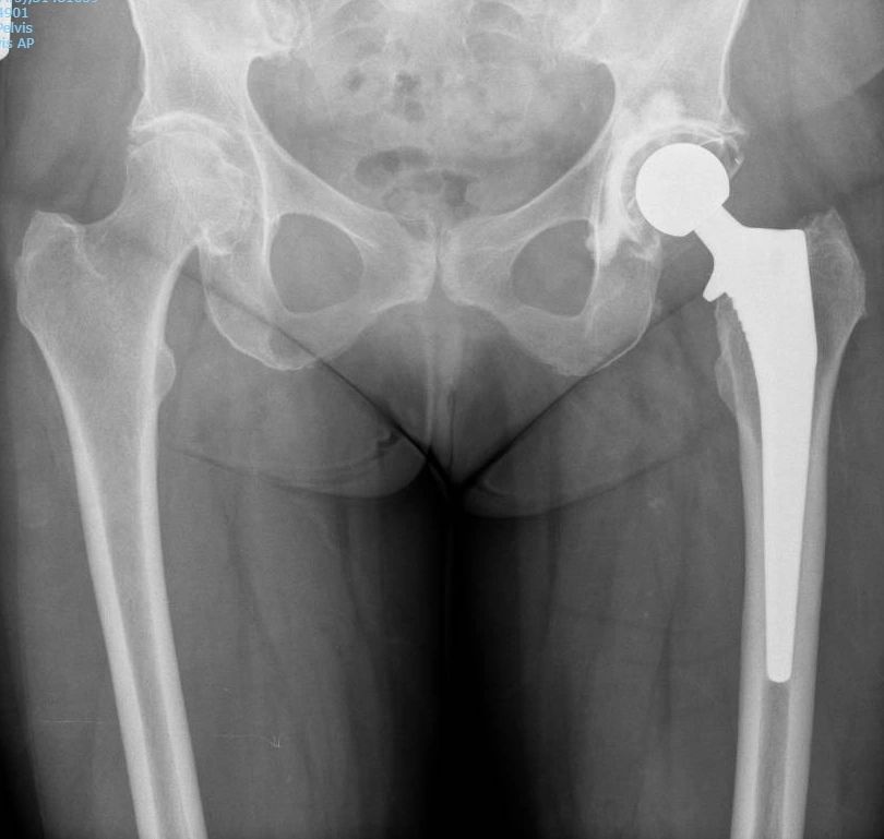 Hip or knee X-ray example