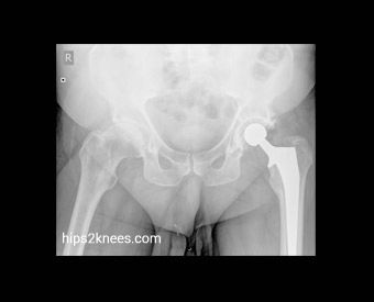 Hip or knee X-ray example
