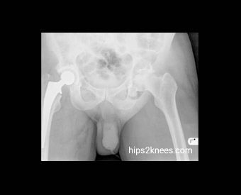 Hip or knee X-ray example