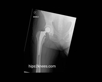 Hip or knee X-ray example
