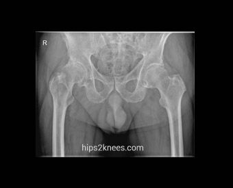 Hip or knee X-ray example