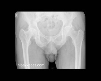 Hip or knee X-ray example