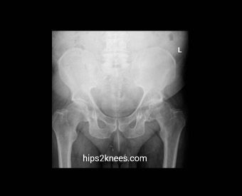 Hip or knee X-ray example