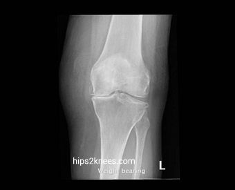 Knee X-ray example
