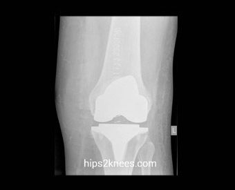 Knee X-ray example