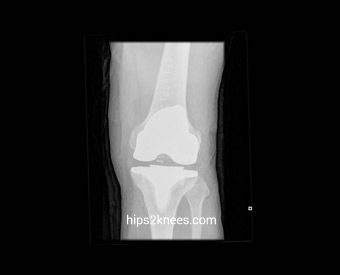 Knee X-ray example