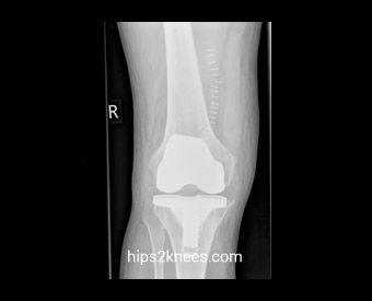 Knee X-ray example