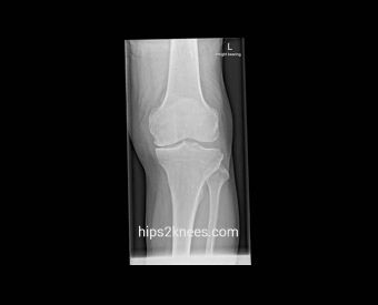 Knee X-ray example