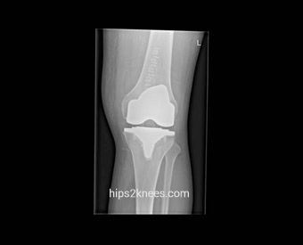 Knee X-ray example