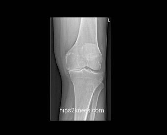 Knee X-ray example