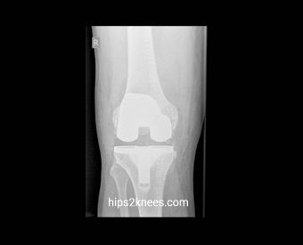 Knee X-ray example