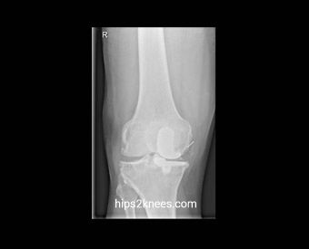 Knee X-ray example