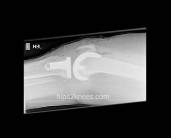 Knee X-ray example