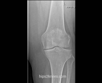 Knee X-ray example