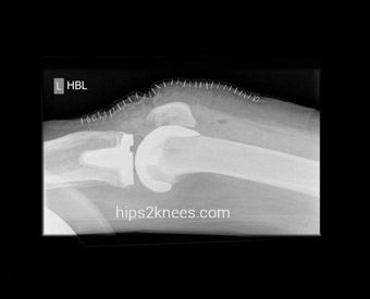 Knee X-ray example