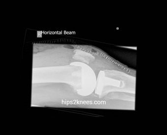 Knee X-ray example