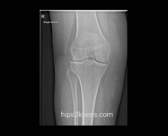 Knee X-ray example