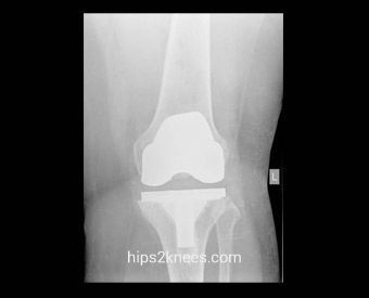 Knee X-ray example