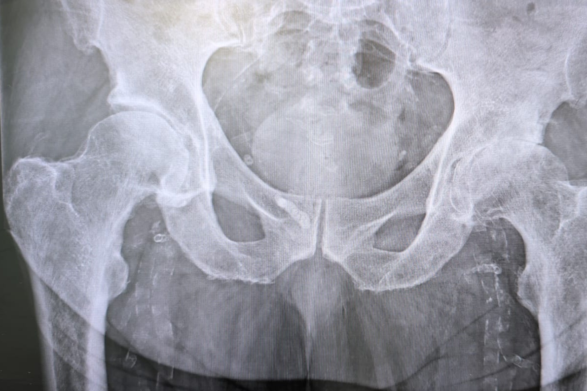 X-ray of the pelvis and both hips